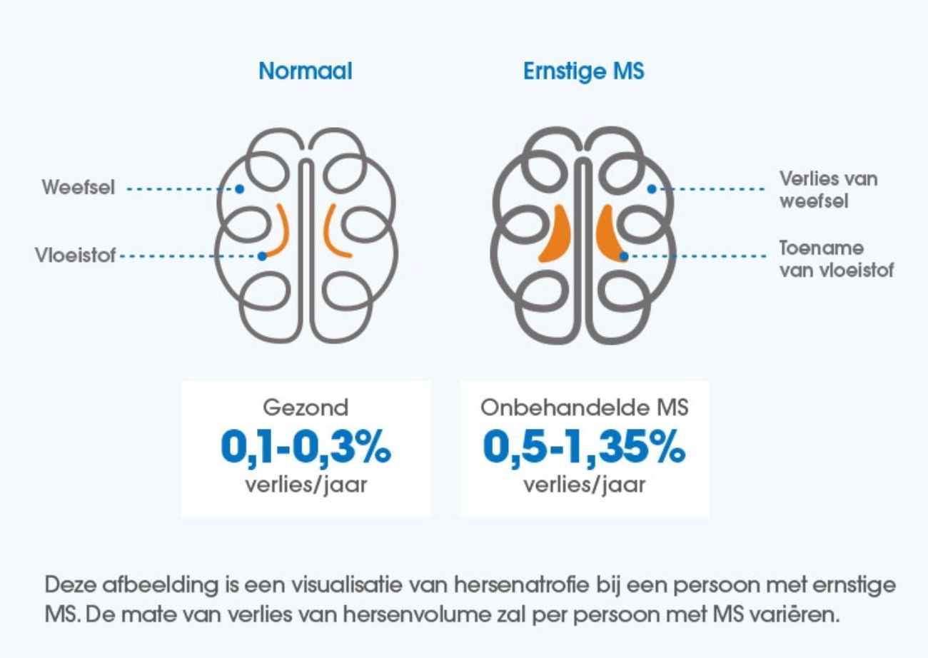 Breinatrofie bij MS