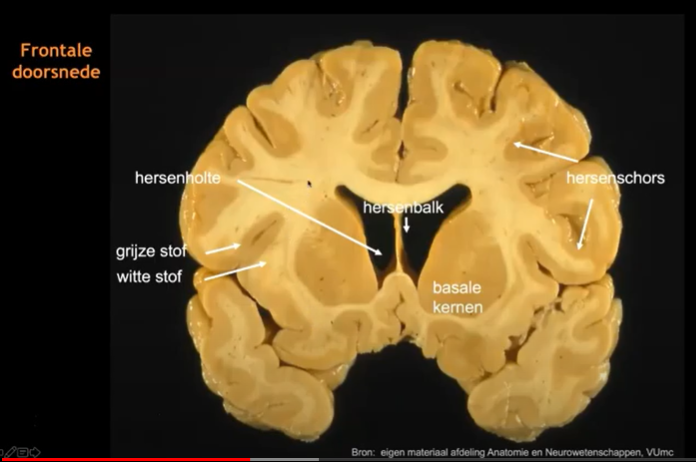 Cognitieve stoornissen en relatie met hersenschade | MSdeBaas