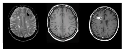 MRI